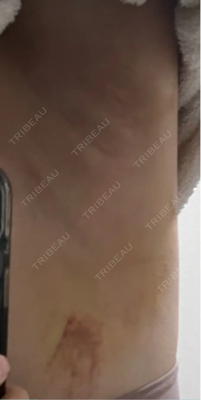 ワキ汗治療（レーザー） Fellez Clinic【フェルズクリニック】 DAY 7 メイン用