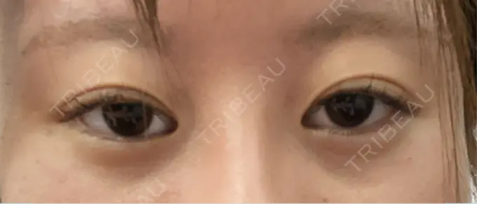 ボトックス（目尻） veary clinic DAY 0 メイン用