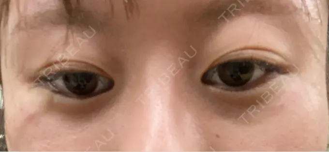 ボトックス（目尻） veary clinic DAY 0 メイン用