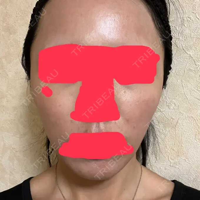 ピコフラクショナルレーザー（毛穴・ニキビ跡） ルラ美容クリニック 大阪本院 DAY 0 メイン用