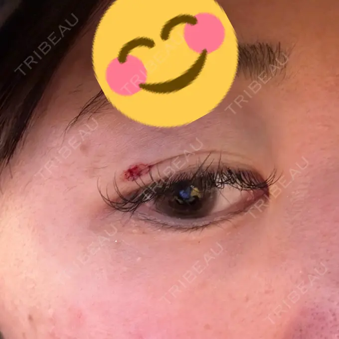 上まぶたの脂肪取り HAAB×DREAM BEAUTY CLINIC 大阪梅田院 DAY 0 メイン用