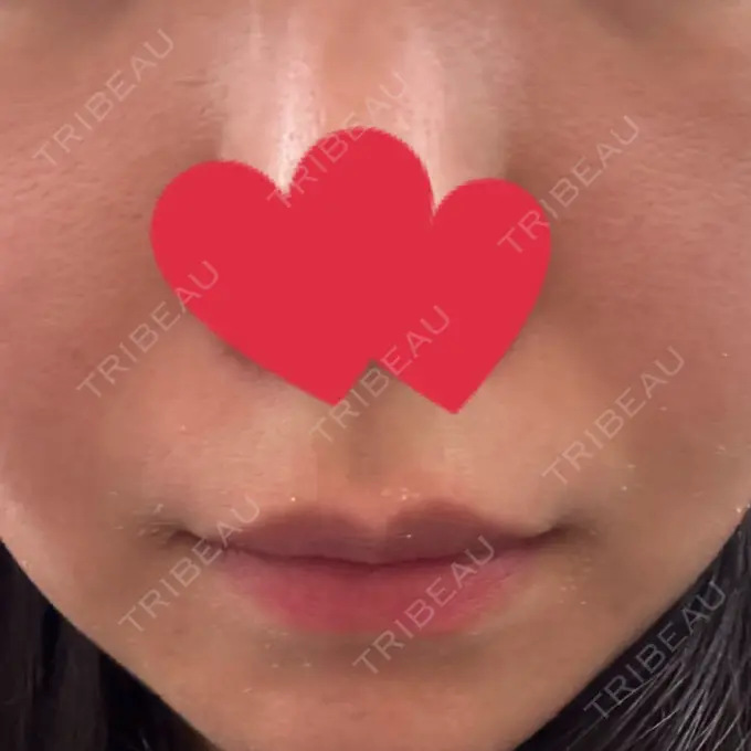 ヒアルロン酸注入（鼻翼基部） THE FIRST CLINIC 町田院 AFTER メイン用