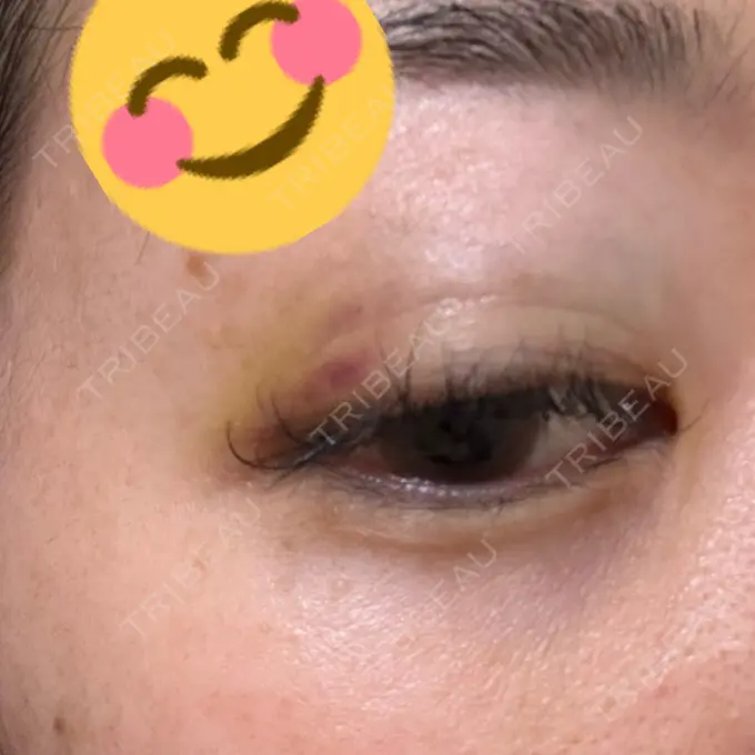 上まぶたの脂肪取り HAAB×DREAM BEAUTY CLINIC 大阪梅田院 DAY 10 メイン用