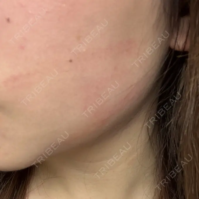 RF（高周波）たるみ治療 大美会クリニック 心斎橋本院 DAY 1 メイン用