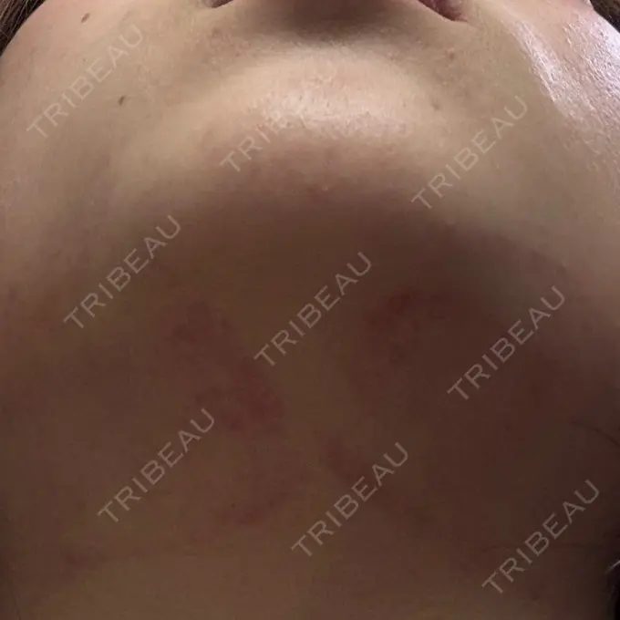 RF（高周波）たるみ治療 大美会クリニック 心斎橋本院 DAY 1 メイン用