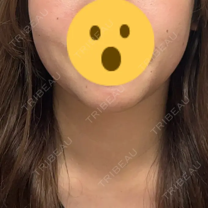 RF（高周波）たるみ治療 大美会クリニック 心斎橋本院 DAY 1 メイン用