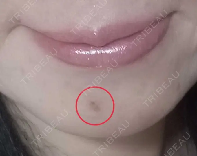 イオン導入 / シミ取りレーザー 湘南美容クリニック 仙台院 DAY 1 メイン用