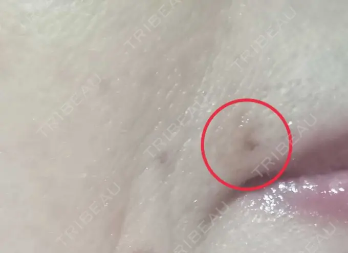 イオン導入 / シミ取りレーザー 湘南美容クリニック 仙台院 DAY 1 メイン用