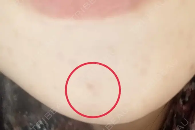 イオン導入 / シミ取りレーザー 湘南美容クリニック 仙台院 DAY 7 メイン用