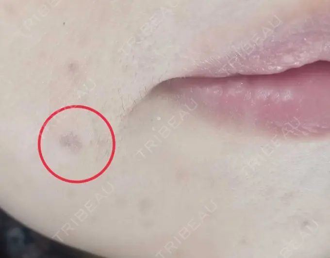 イオン導入 / シミ取りレーザー 湘南美容クリニック 仙台院 DAY 7 メイン用