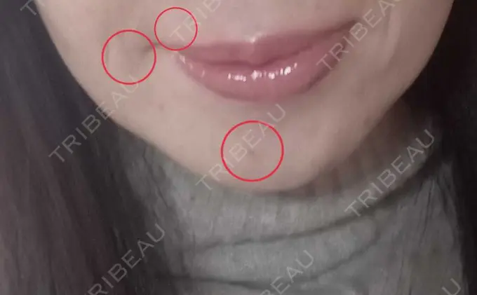 イオン導入 / シミ取りレーザー 湘南美容クリニック 仙台院 DAY 10 メイン用