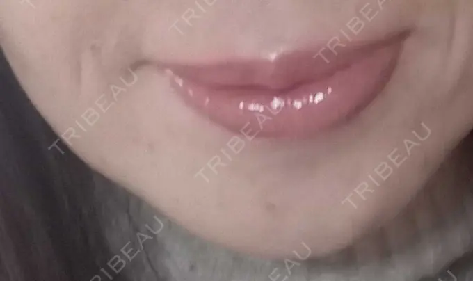 イオン導入 / シミ取りレーザー 湘南美容クリニック 仙台院 DAY 10 メイン用