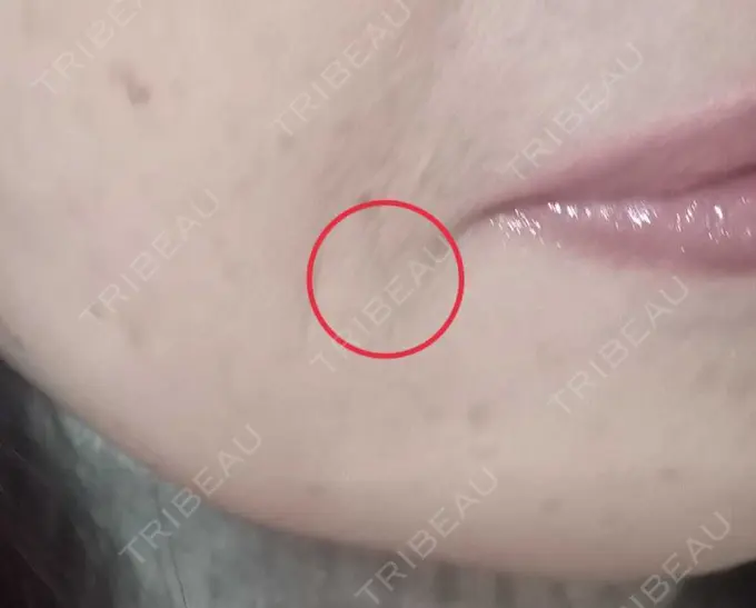 イオン導入 / シミ取りレーザー 湘南美容クリニック 仙台院 AFTER メイン用