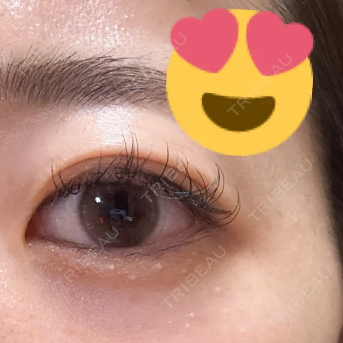 上まぶたの脂肪取り HAAB×DREAM BEAUTY CLINIC 大阪梅田院 DAY 12 メイン用