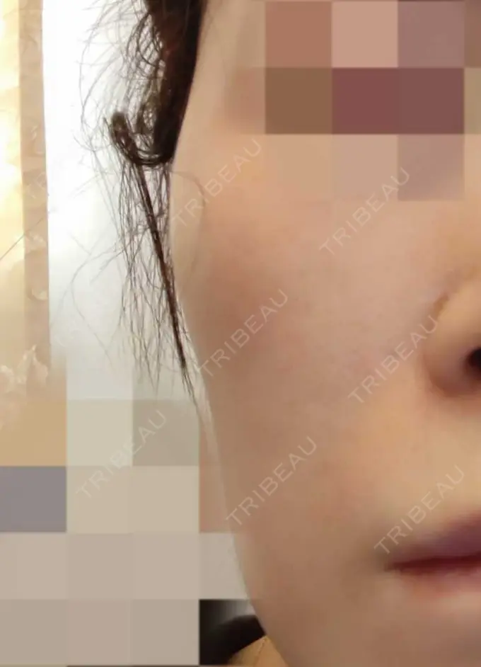 肌育注射（ジュベルックなど） おおしま皮膚科 DAY 6 メイン用