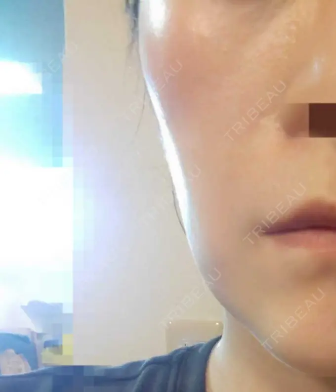 肌育注射（ジュベルックなど） おおしま皮膚科 DAY 7 メイン用