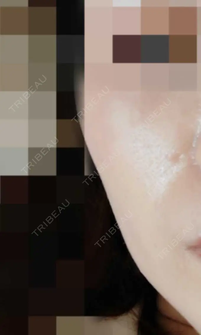 肌育注射（ジュベルックなど） おおしま皮膚科 DAY 14 メイン用