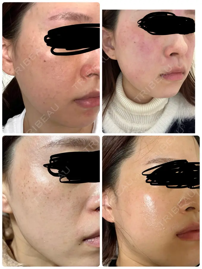 ルメッカ MIO CLINIC 梅田院 AFTER メイン用