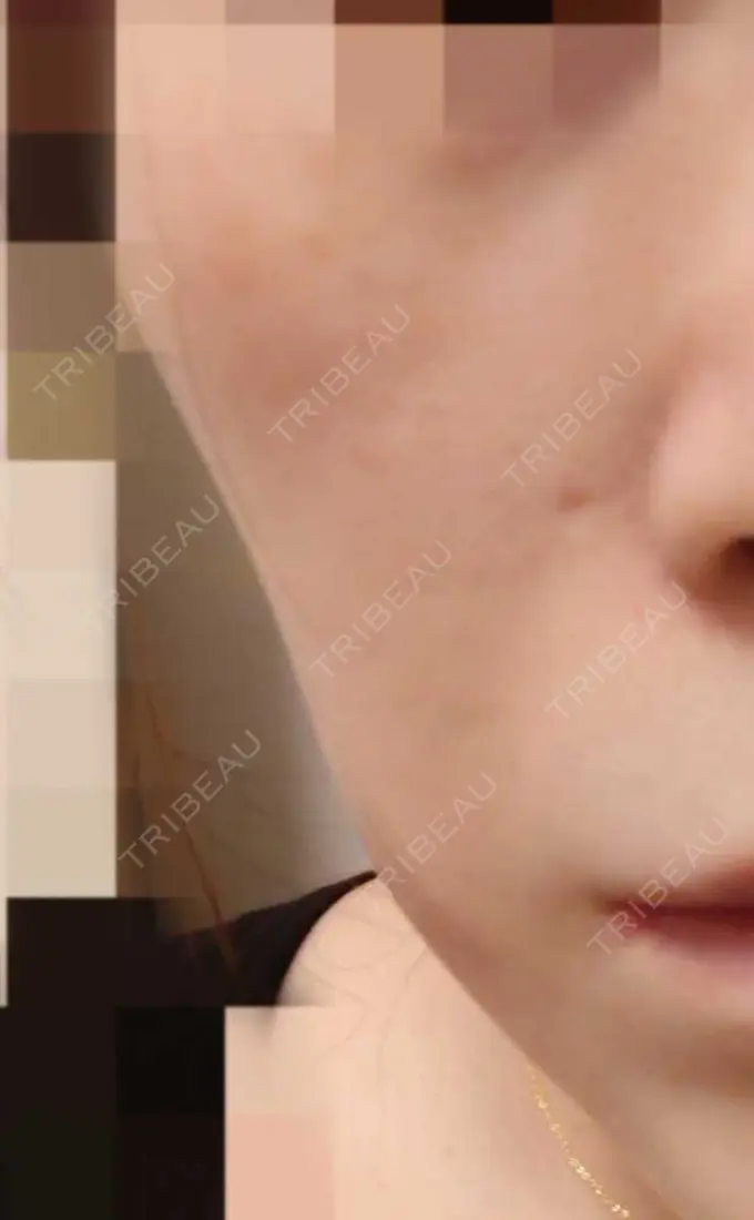 肌育注射（ジュベルックなど） おおしま皮膚科 DAY 35 メイン用