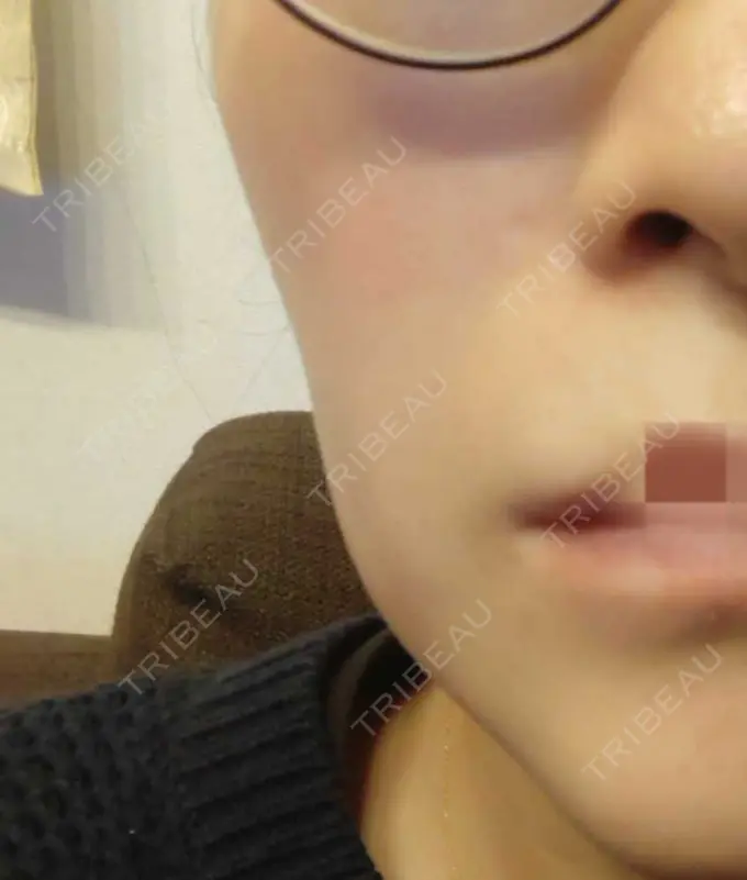 肌育注射（ジュベルックなど） おおしま皮膚科 DAY 104 メイン用