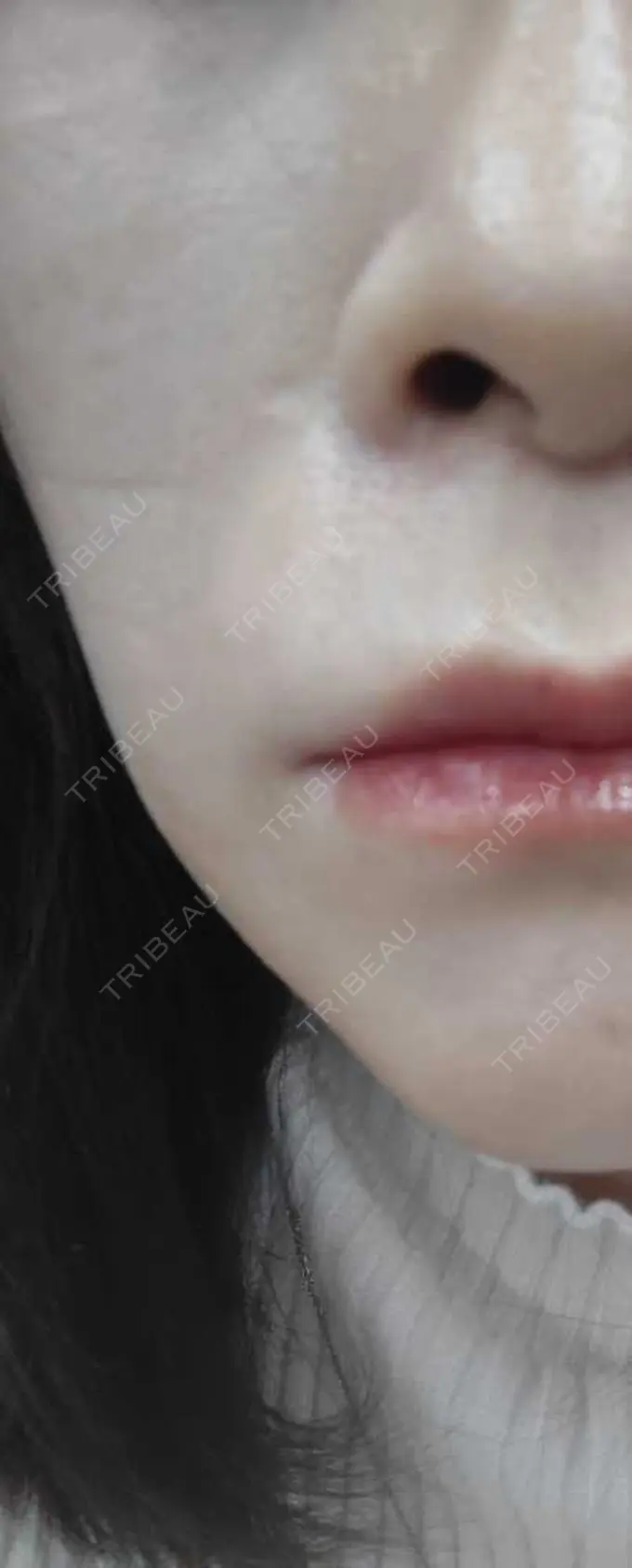 肌育注射（ジュベルックなど） おおしま皮膚科 DAY 112 メイン用