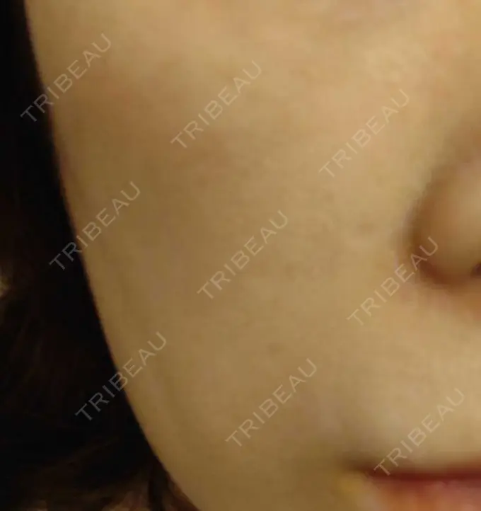 肌育注射（ジュベルックなど） おおしま皮膚科 DAY 118 メイン用