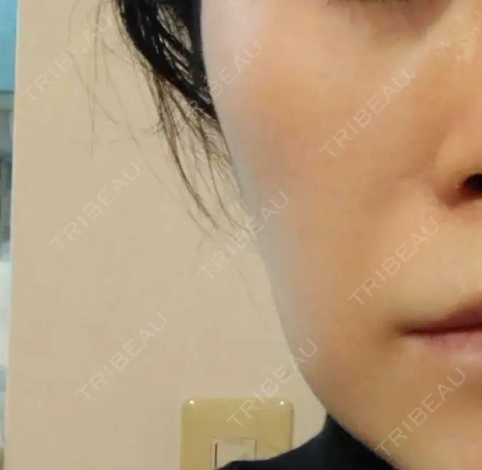 肌育注射（ジュベルックなど） おおしま皮膚科 AFTER メイン用