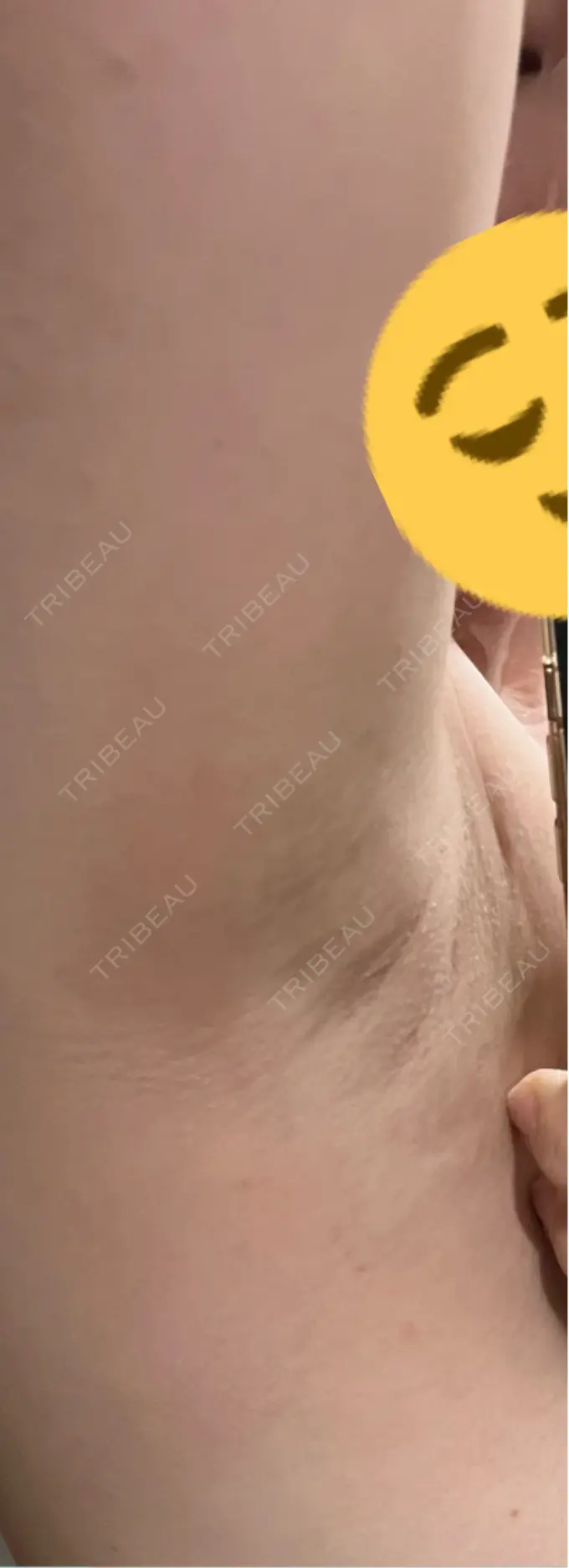 ワキ汗治療（レーザー） Fellez Clinic【フェルズクリニック】 DAY 10 メイン用