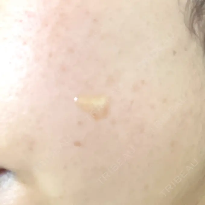 ほくろ・いぼ除去レーザー（肌） Mavie Beauty Clinic （マヴィービューティークリニック） DAY 0 メイン用