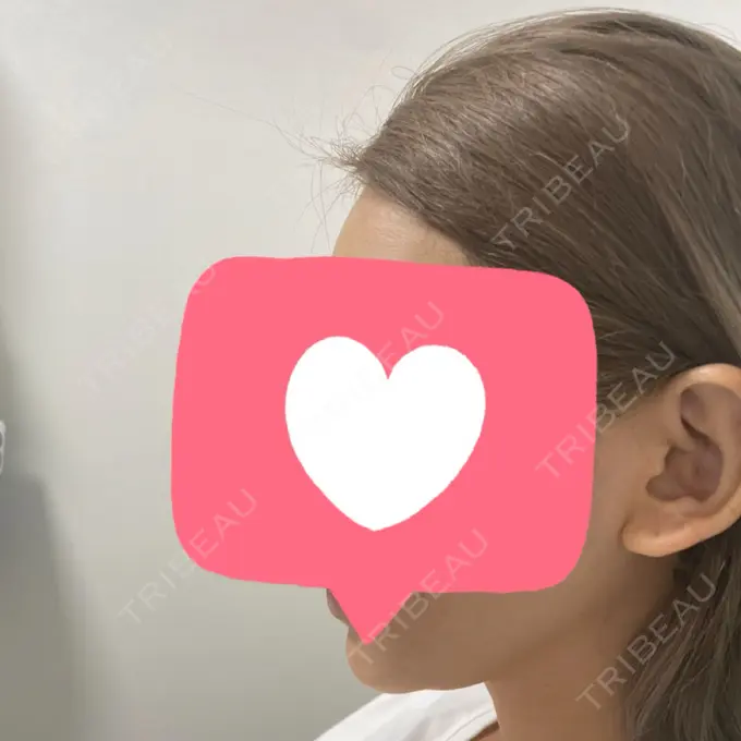 その他（肌） ルラ美容クリニック 仙台院 / ルラスキンクリニック 仙台院 DAY 0 メイン用