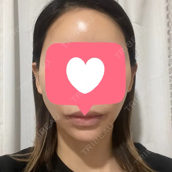 その他（肌） ルラ美容クリニック 仙台院 / ルラスキンクリニック 仙台院 DAY 3 メイン用