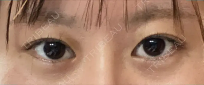 ボトックス（目尻） veary clinic DAY 2 メイン用