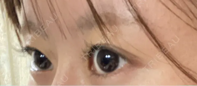 ボトックス（目尻） veary clinic DAY 2 メイン用