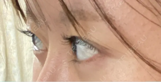 ボトックス（目尻） veary clinic DAY 2 メイン用