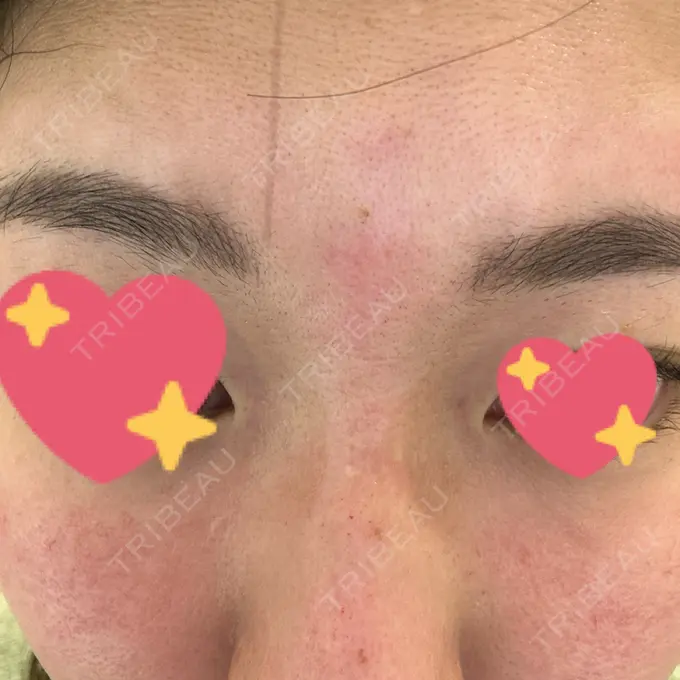 ピーリング（ニキビ・毛穴） / ポテンツァ ルラ美容クリニック 札幌本院 DAY 0 メイン用