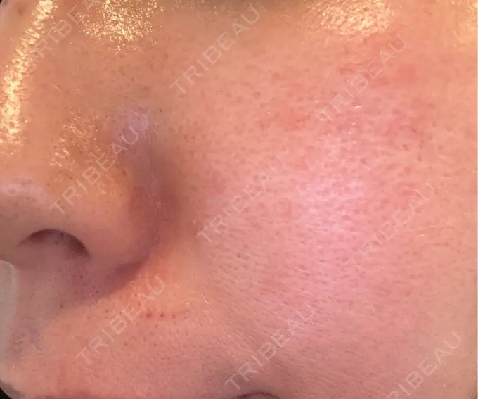 ピーリング（ニキビ・毛穴） / ポテンツァ ルラ美容クリニック 札幌本院 DAY 0 メイン用