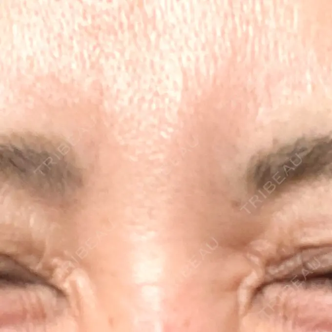 シワ取りボトックス / ボトックス（眉間） TCB東京中央美容外科 神戸院 DAY 37 メイン用