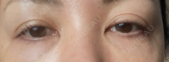 クマ治療 / 下まぶたたるみ取り / ヒアルロン酸注入（目の下） / ボトックス（目尻） TCB東京中央美容外科 神戸院 AFTER メイン用