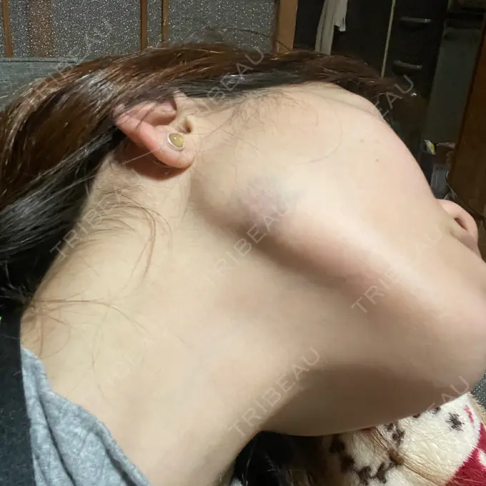 ボトックス（エラ・小顔） TCB東京中央美容外科 大分院 DAY 1 メイン用