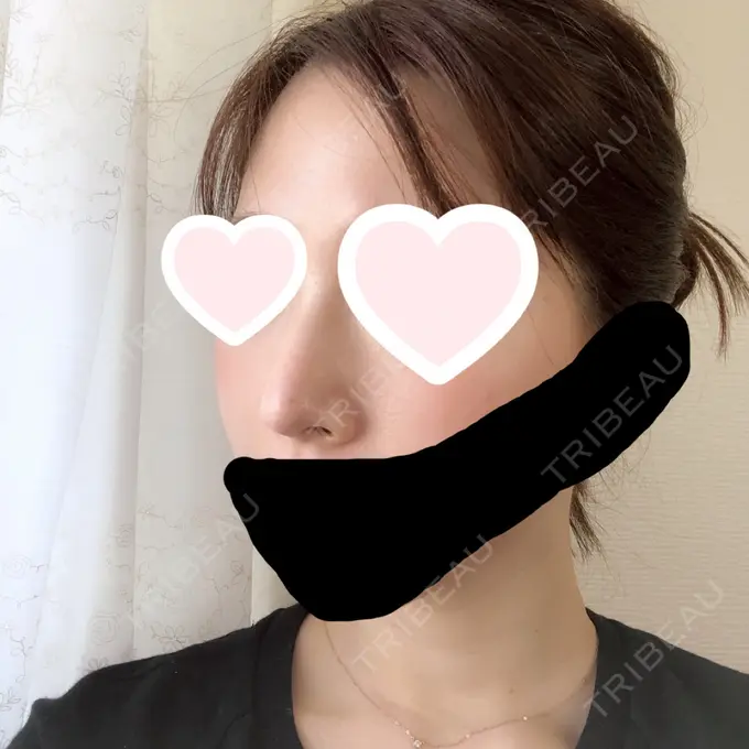 鼻尖形成（切開） / 軟骨移植 グローバルビューティークリニック 大阪院 AFTER メイン用