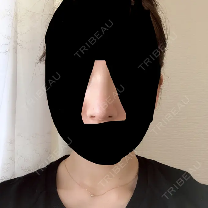 鼻尖形成（切開） / 軟骨移植 グローバルビューティークリニック 大阪院 DAY 84 メイン用