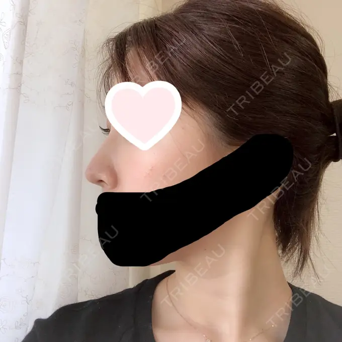 鼻尖形成（切開） / 軟骨移植 グローバルビューティークリニック 大阪院 DAY 84 メイン用