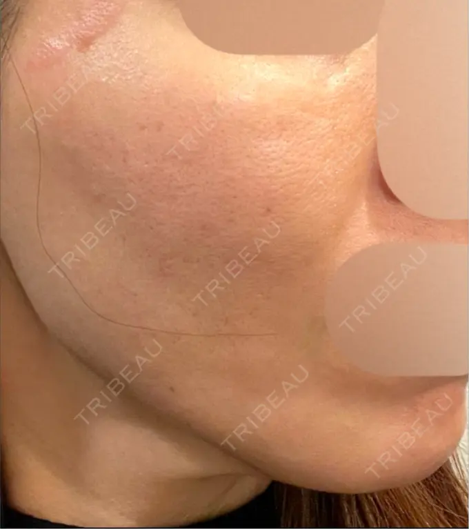 医療脱毛（顔） しんゆり美容健康クリニック DAY 0 メイン用