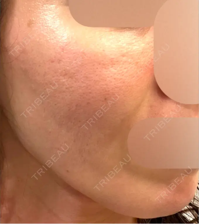 医療脱毛（顔） しんゆり美容健康クリニック AFTER メイン用