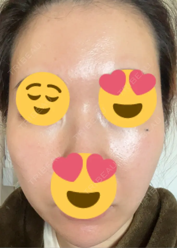 ピーリング（ニキビ・毛穴） / ヴェルヴェットスキン / ピーリング（ハリ・ツヤ） ミニマムスキンクリニック池袋 DAY 8 メイン用