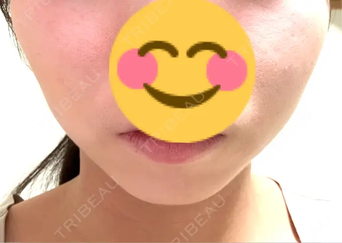 ボトックス（エラ・小顔） / 脂肪溶解注射（顔） 仙台N美容クリニック AFTER メイン用