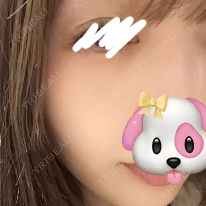 美肌レーザー / 美白レーザー / ピコレーザートーニング（美白・肝斑） 銀座みゆき通り美容外科 大阪梅田院 AFTER メイン用