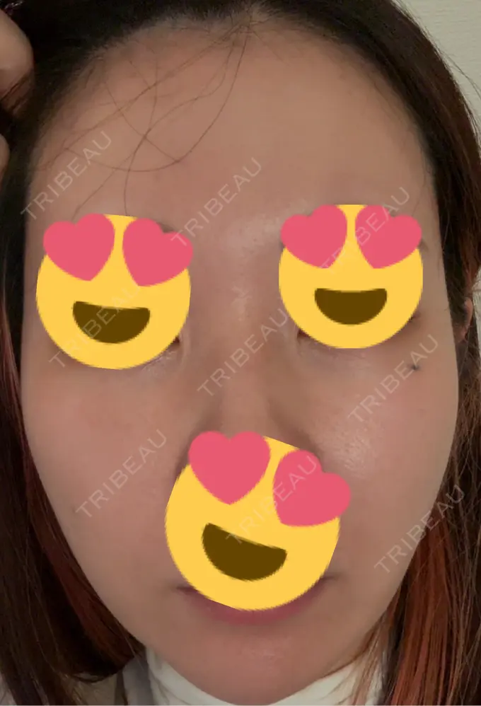 ピーリング（ニキビ・毛穴） / ヴェルヴェットスキン / ピーリング（ハリ・ツヤ） ミニマムスキンクリニック池袋 AFTER メイン用