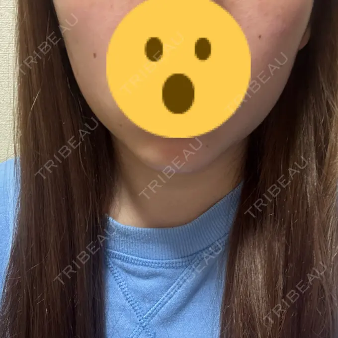 RF（高周波）たるみ治療 大美会クリニック 心斎橋本院 AFTER メイン用