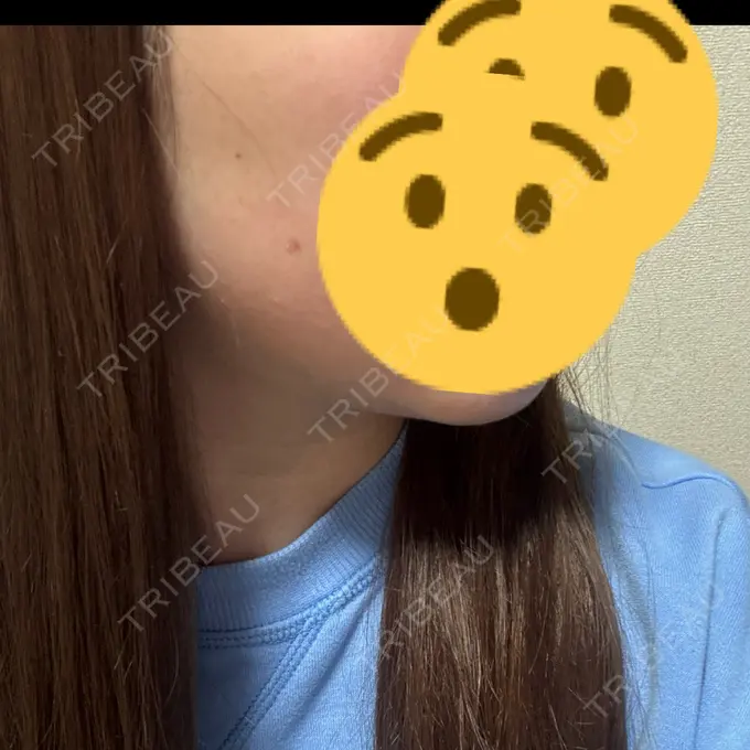 RF（高周波）たるみ治療 大美会クリニック 心斎橋本院 DAY 7 メイン用